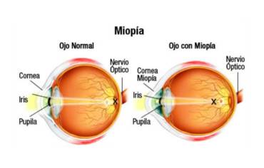 Las causas de la miopía